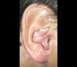 Spider In Ear: Arachnid ‘Filmed In Swimmer’s Infected Ear Canal’