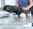 Elite swimmer from Bedford undergoes second experimental leg amputation