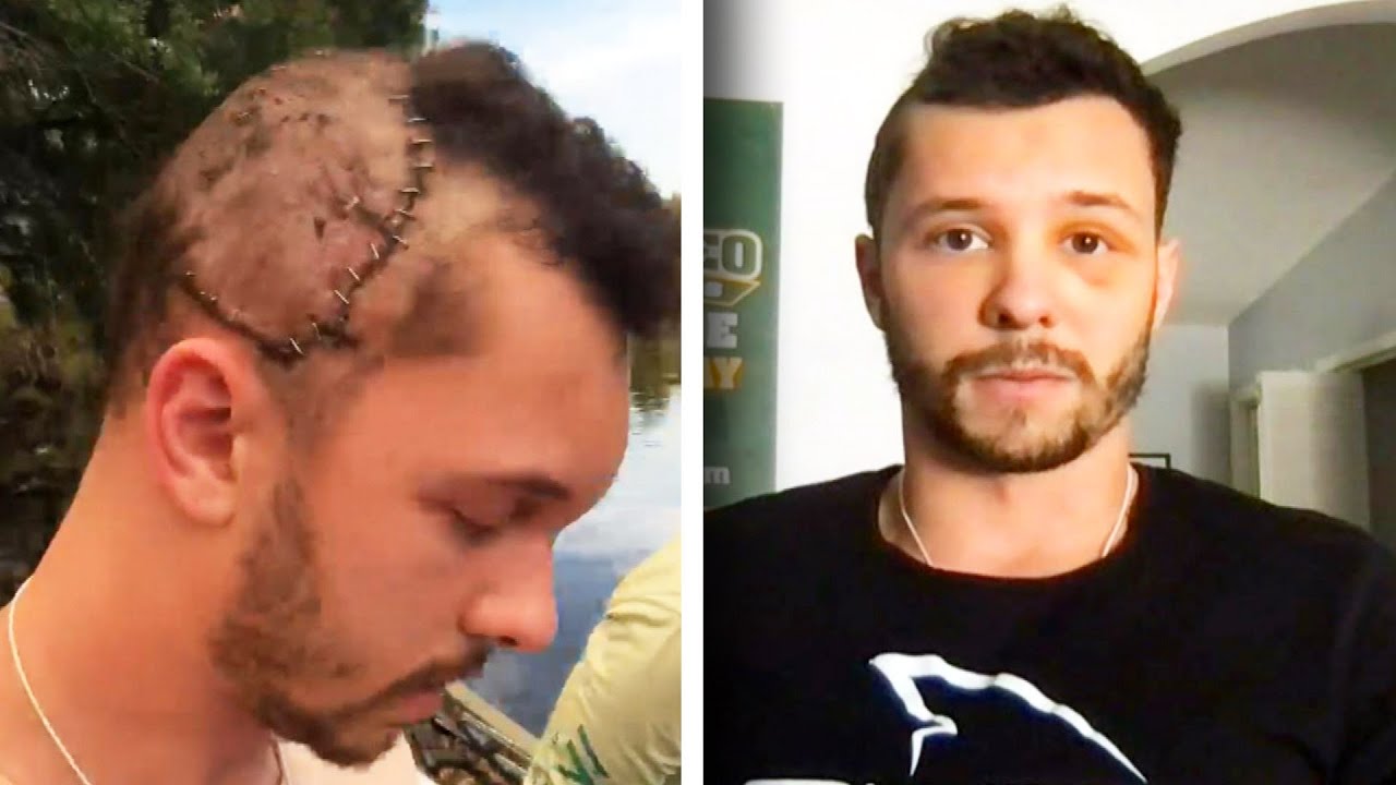 Diver Survives Alligator Bite That Fractured His Skull | Inside Edition