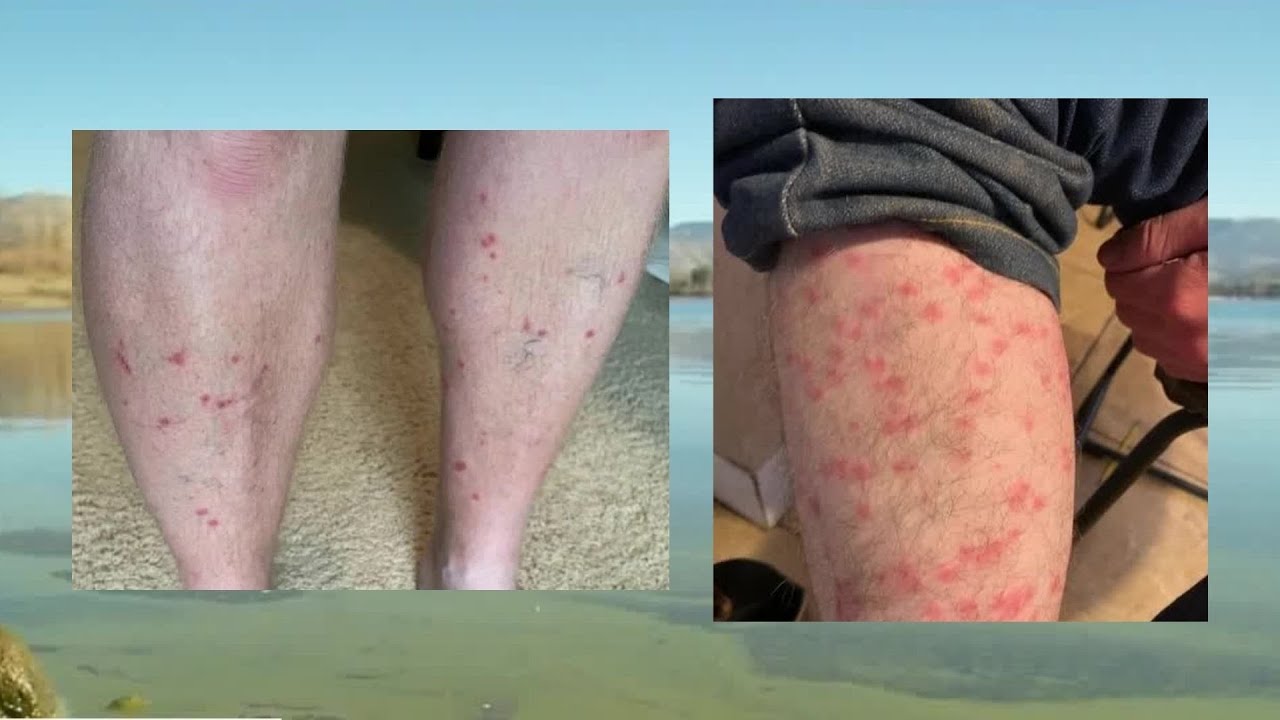 Health Officials Warn Of ‘Swimmer’s Itch’ in Utah Lakes and Ponds | FOX 13 News Utah